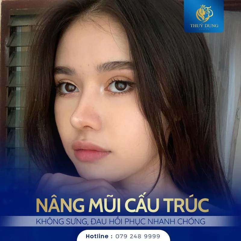 nâng mũi cấu trúc